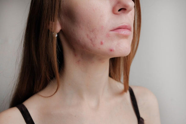 Adult acne - why do I still get acne in my 30's?
